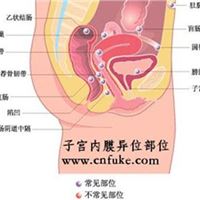 治疗子宫内膜异位症沈阳子宫内膜异位症天华中医妇科